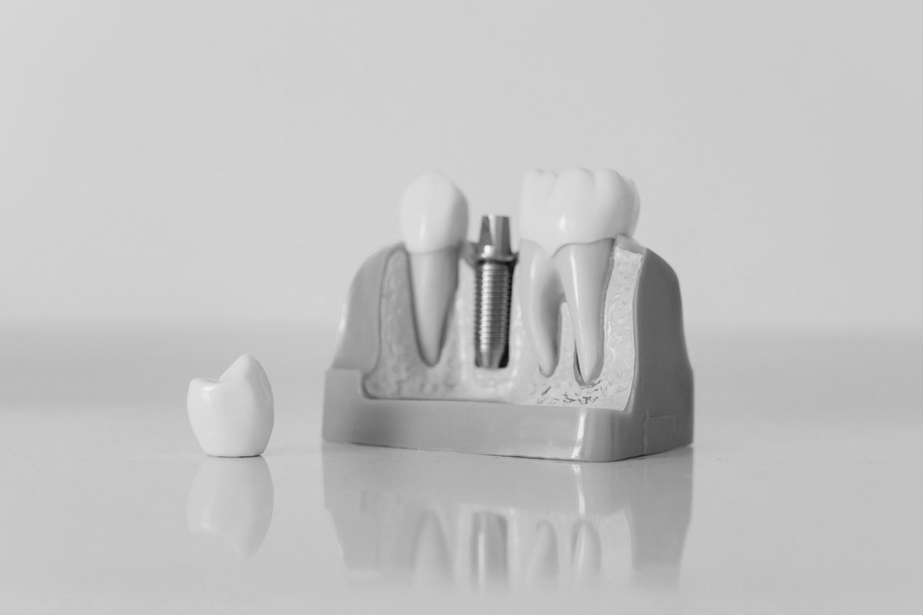 Corona dental sobre implante — Dental Internacional, Tenerife