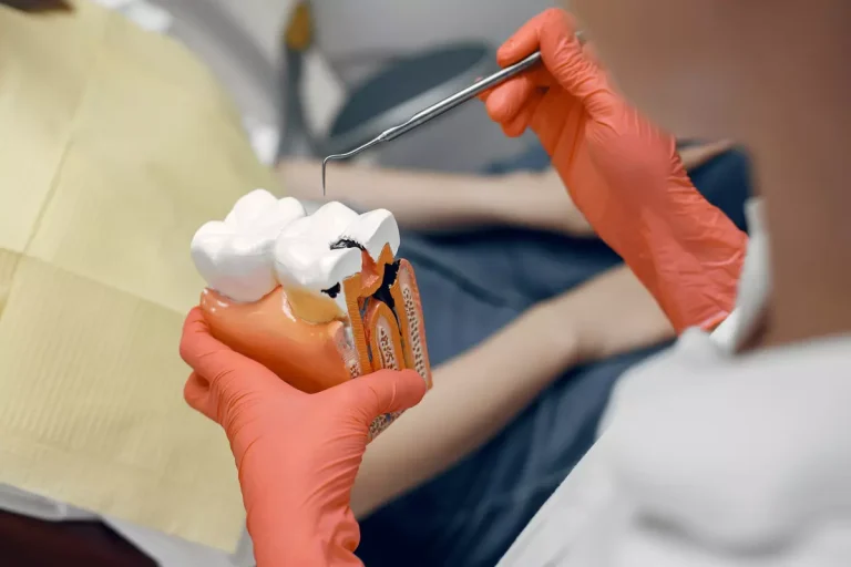 Caries en los dientes: Guía completa con todo lo que necesitas saber