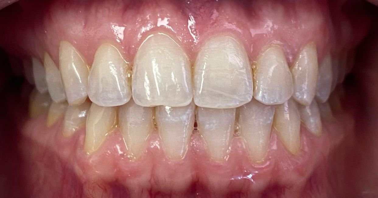 Antes del blanqueamiento dental