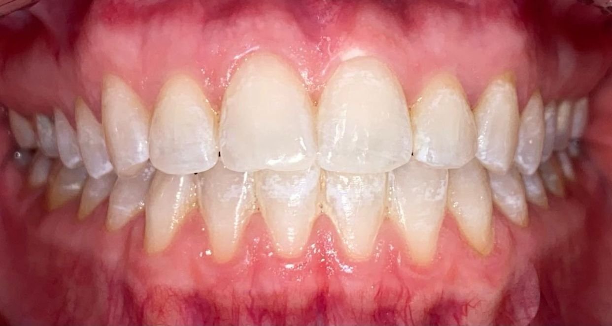 Después del blanqueamiento dental