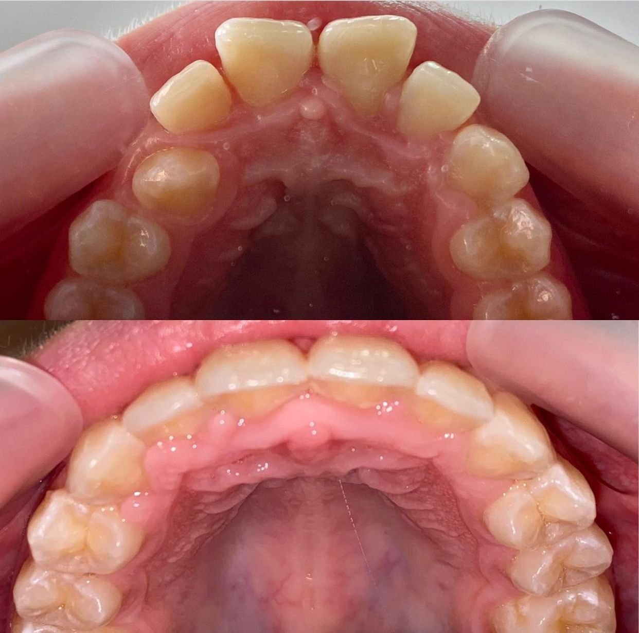 Resultado ortodoncia Tenerife