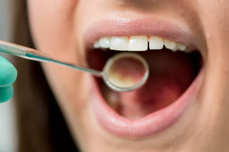 Manchas blancas en los dientes: Qué son y cómo eliminarlas
