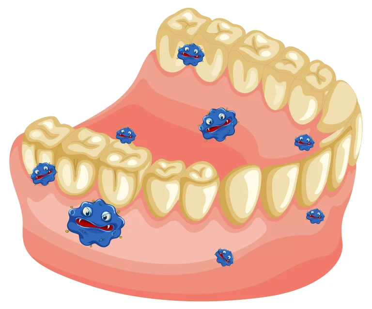 Placa bacteriana: Causas, consecuencias y tratamientos