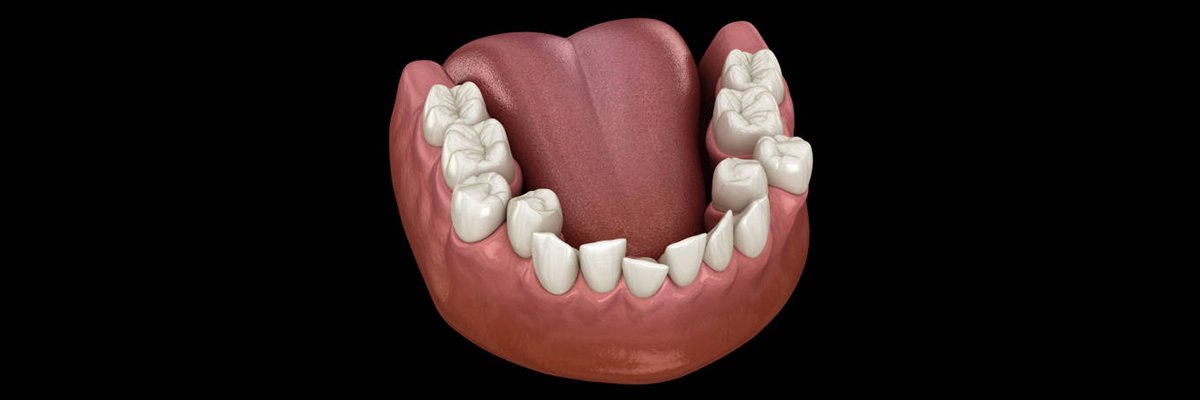 Apiñamiento dental leve: Todo lo que necesitas saber y más