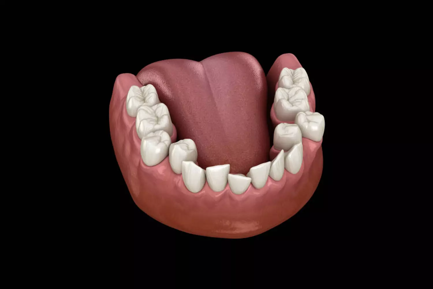 Apiñamiento dental leve: Todo lo que necesitas saber y más