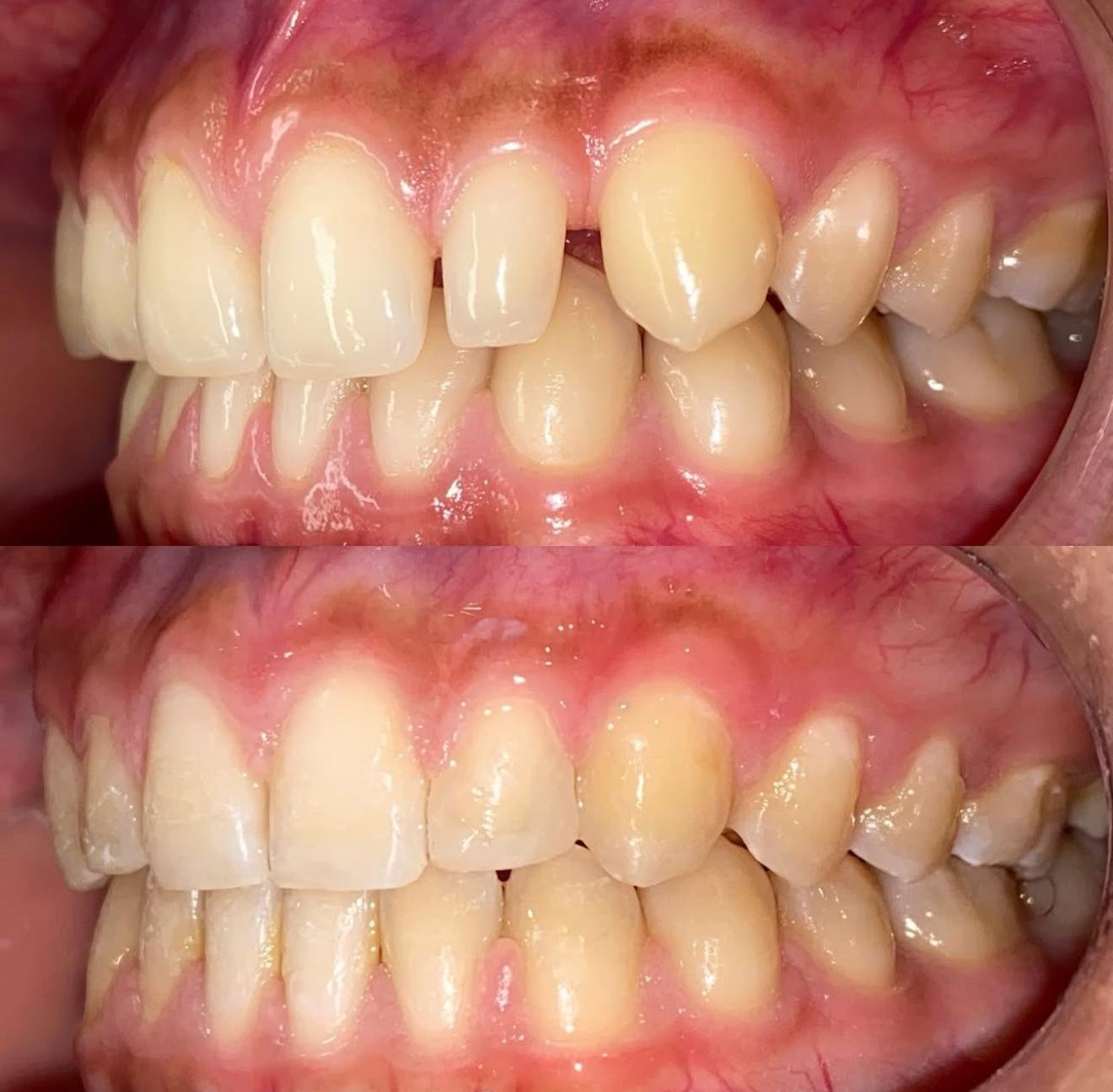 Caso de ortodoncia Dental Internacional