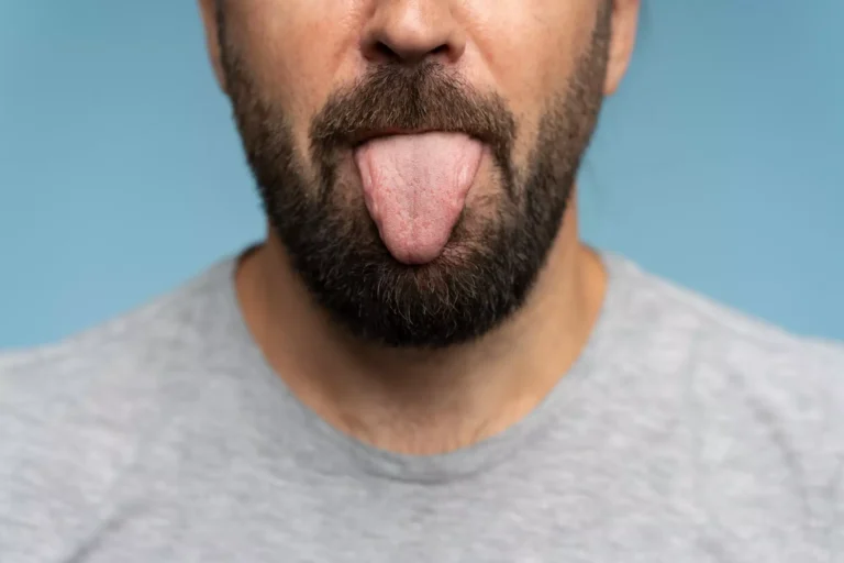 Lengua saburral en un paciente